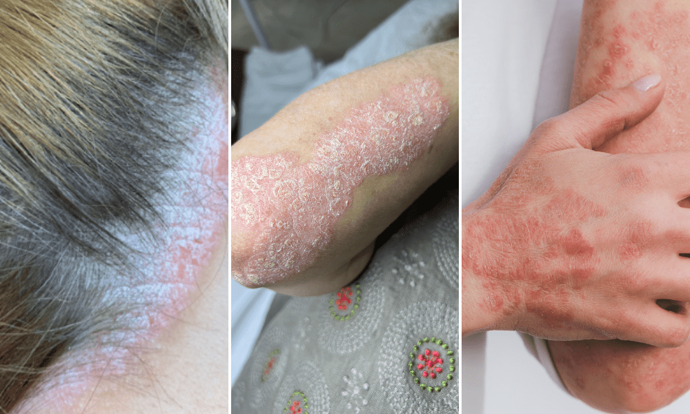 Psoriasis