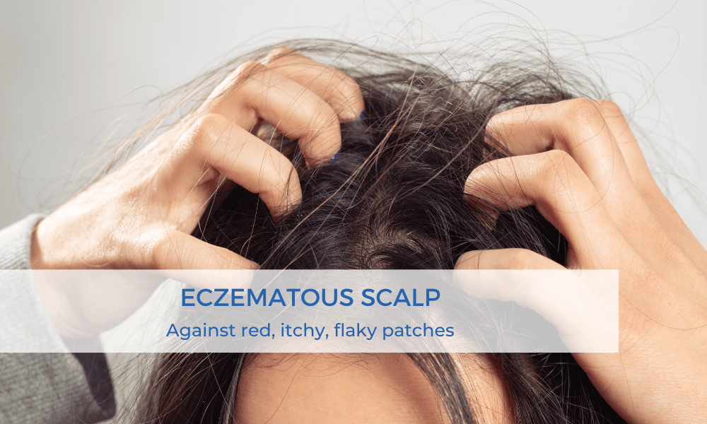 Eczematous Scalp