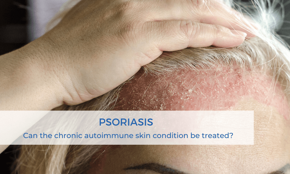 Psoriasis