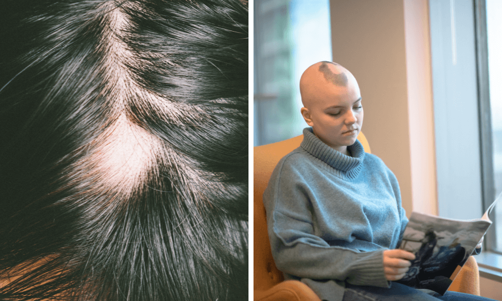 Alopecia