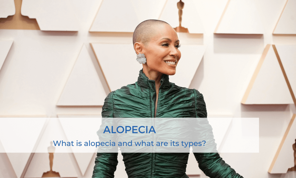 Alopecia