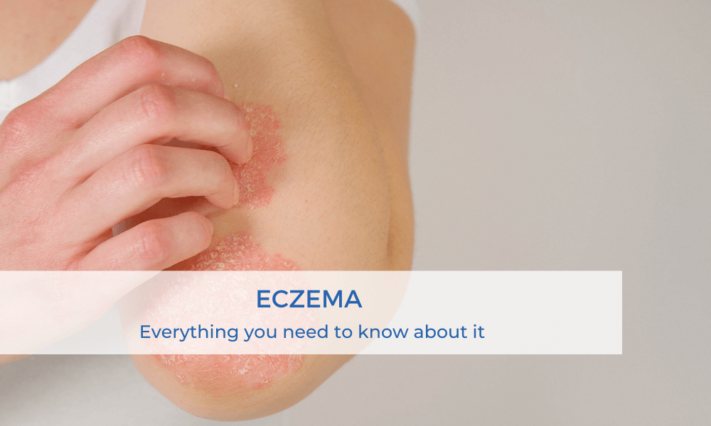 eczema