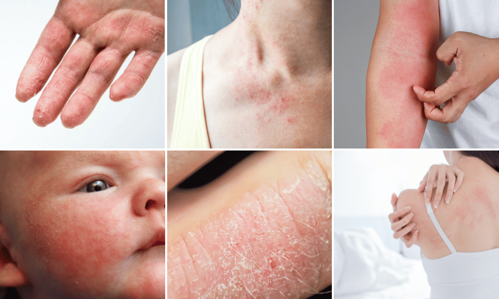 eczema