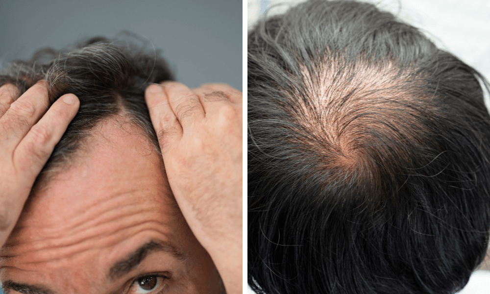 Men's hair care - Against men hair loss baldness